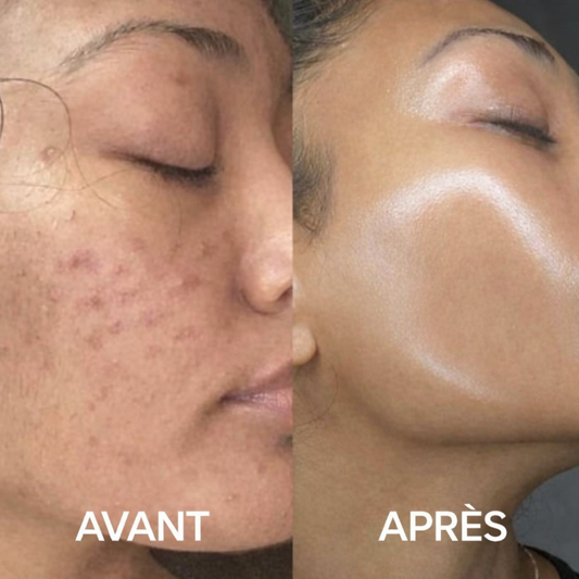 Extracteur de Points Noirs Professionnel rechargeable